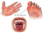 Thông điệp truyền thông phòng, chống bệnh tay chân miệng